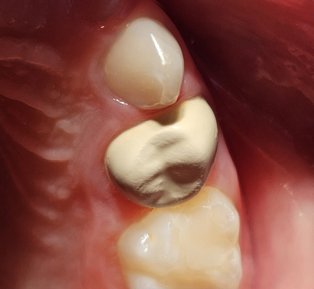 BioFlx clinical case by Jennifer Mai