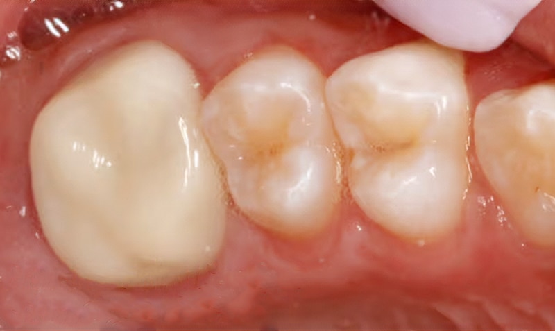 ZR Permanent Molar case by Alejandro Ramirez