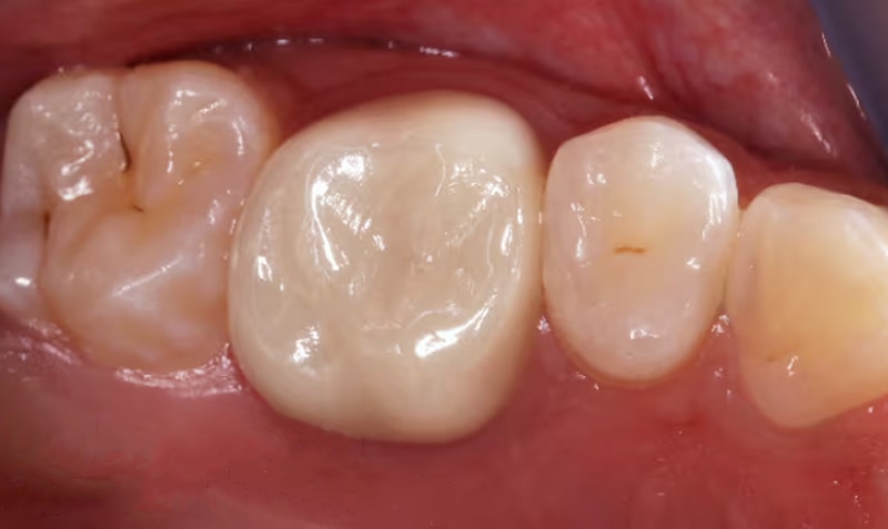 ZR Permanent Molar case by Jorge Casian