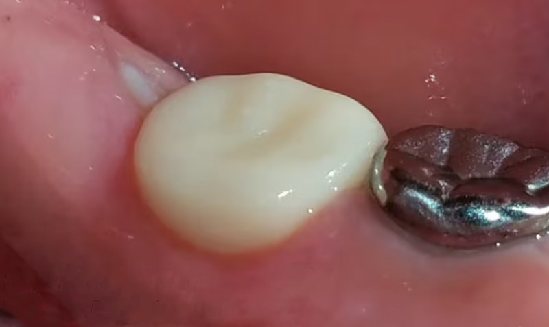 ZR Permanent Molar case by Paul Bahn